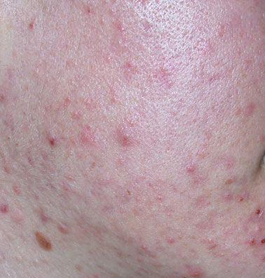 Acne vulgaris