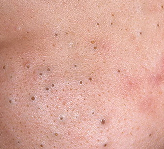 Blackheads