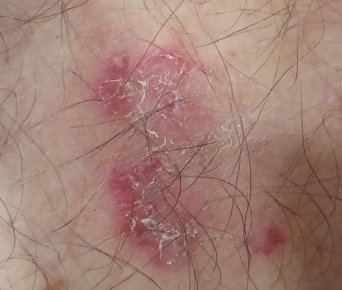 Mycosis