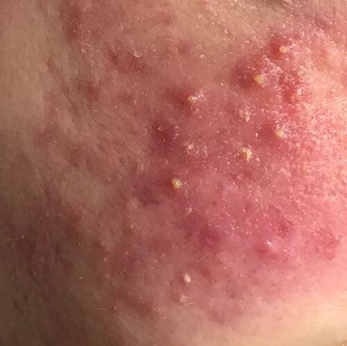 Acne pustular