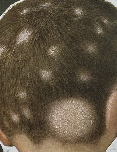Hair fungus