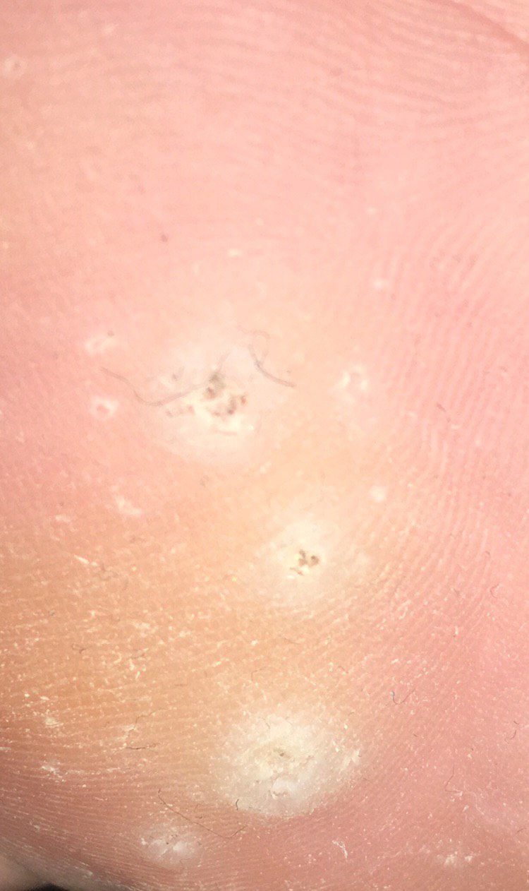 Wart plantar
