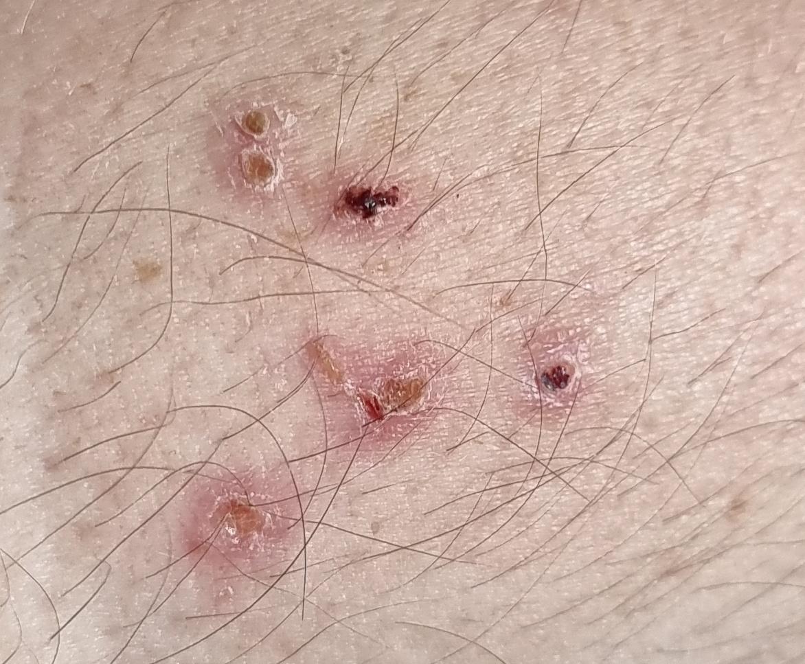 Chickenpox