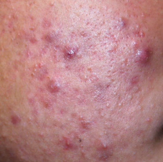papules
