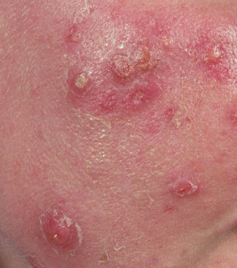 pustules