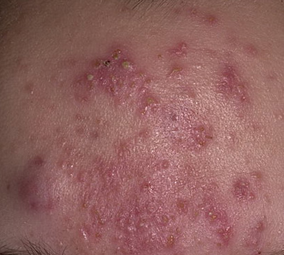 acne cystic
