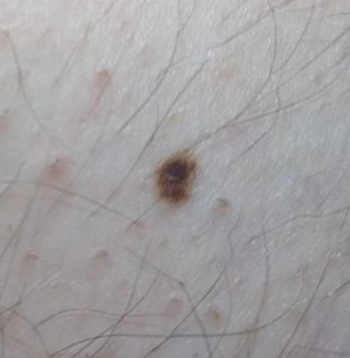 skin moles